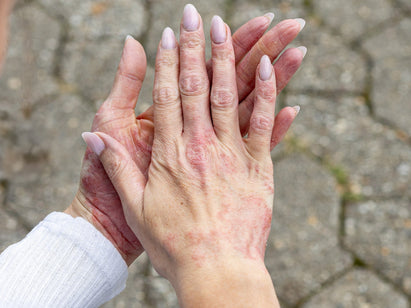 eczema on womans hands